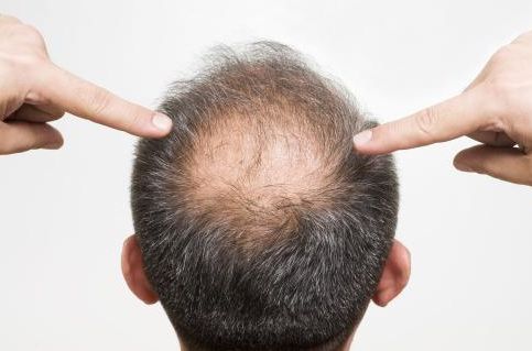 是什么引起脂溢性脱发的？
